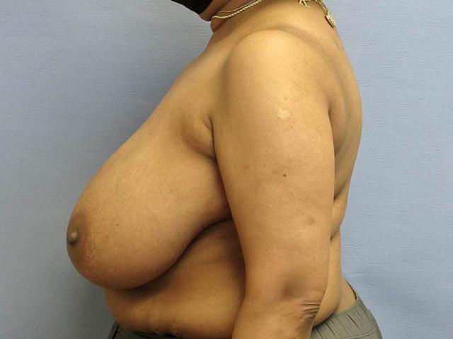 Breast Augmentation before at Parkcrest Plastic Surgery in St. Louis, MO