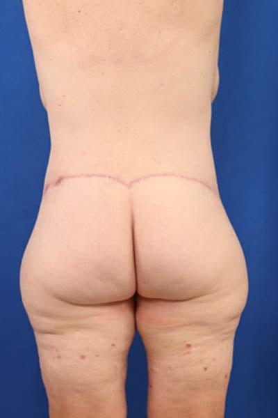 Seacoast Plastic Surgery and Medical Aesthetics body lift after — Portsmouth, NH