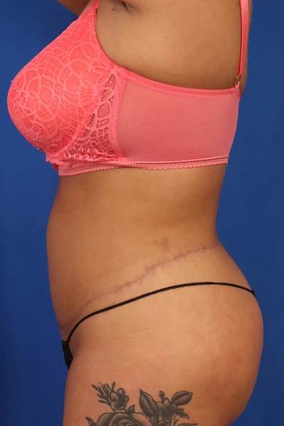 Seacoast Plastic Surgery and Medical Aesthetics body lift after — Portsmouth, NH