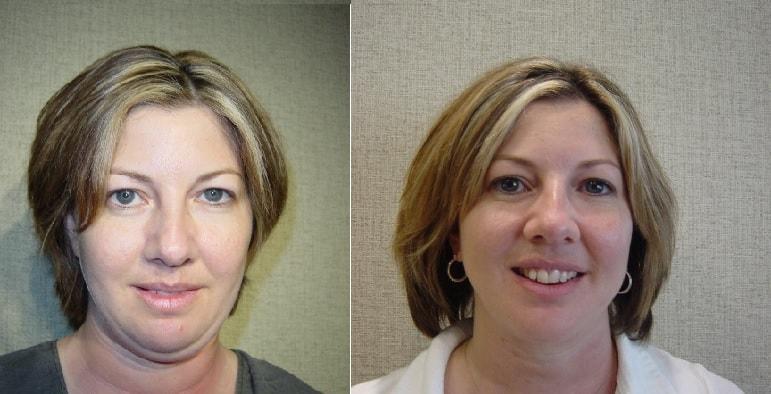 John S. Lee, MD neck liposuction result — Beaverton, OR