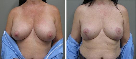 John S. Lee, MD breast implant removal result — Beaverton, OR