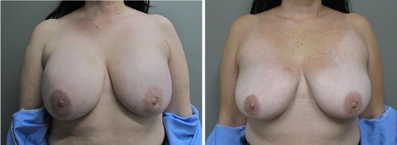 John S. Lee, MD breast implant removal result — Beaverton, OR