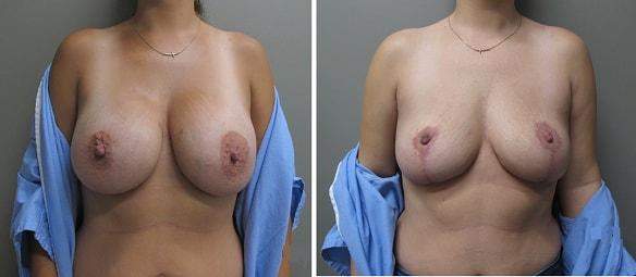 John S. Lee, MD breast implant removal result — Beaverton, OR