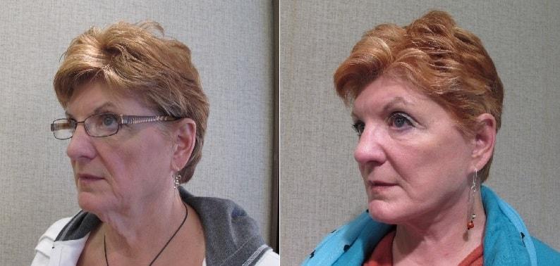 John S. Lee, MD neck lift result — Beaverton, OR