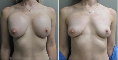 John S. Lee, MD breast implant removal result — Beaverton, OR