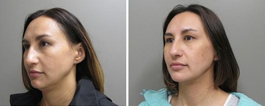 John S. Lee, MD neck liposuction result — Beaverton, OR