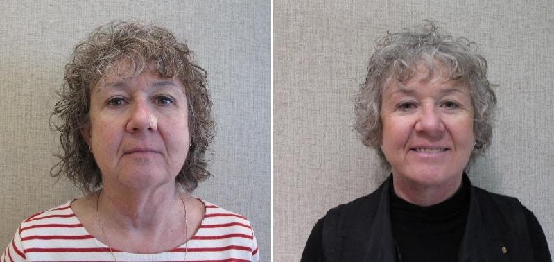 John S. Lee, MD neck lift result — Beaverton, OR