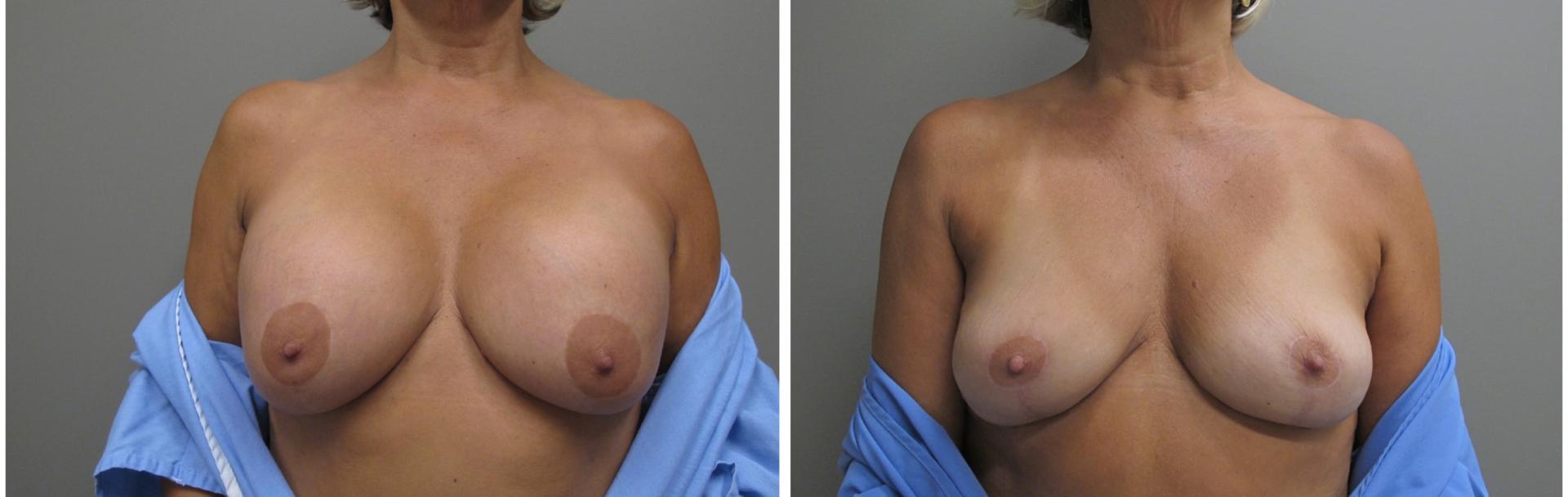 John S. Lee, MD breast implant removal result — Beaverton, OR