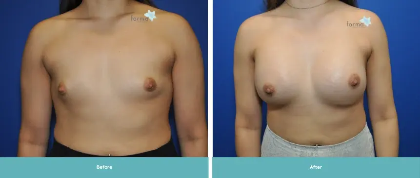 Forma Plastic Surgery breast augmentation result — Phoenix, AZ