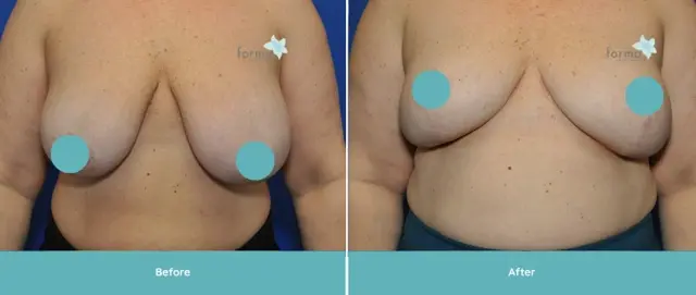 Breast Reduction result at Forma Plastic Surgery in Scottsdale, AZ