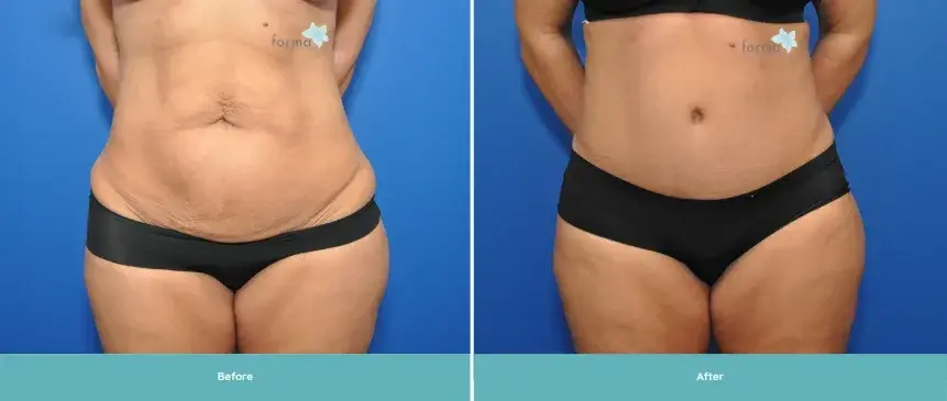 Forma Plastic Surgery tummy tuck result — Scottsdale, AZ