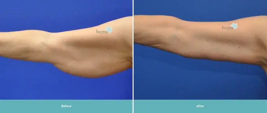 Forma Plastic Surgery arm lift result — Scottsdale, AZ