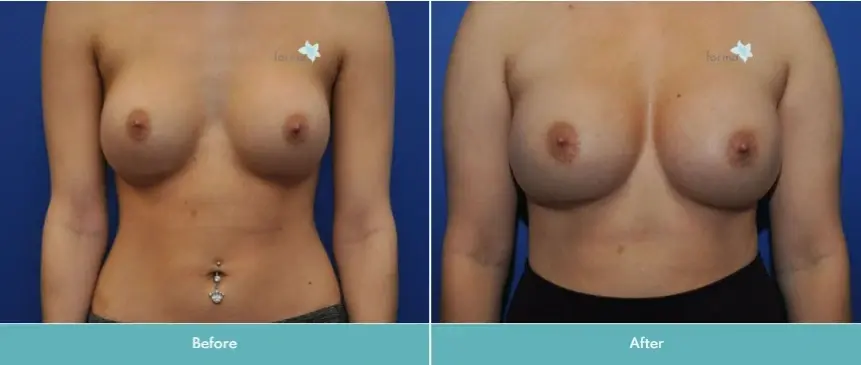 Forma Plastic Surgery breast augmentation revision result — Scottsdale, AZ