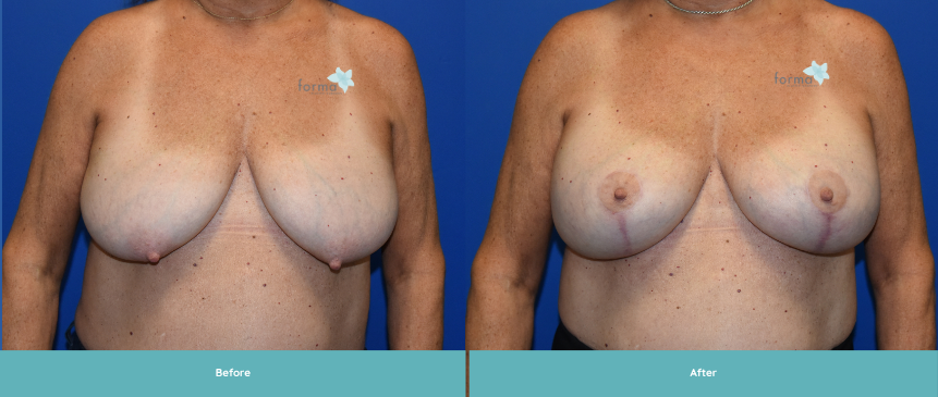Forma Plastic Surgery breast augmentation result — Phoenix, AZ