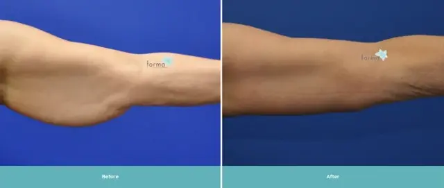 Arm Lift result at Forma Plastic Surgery in Scottsdale, AZ