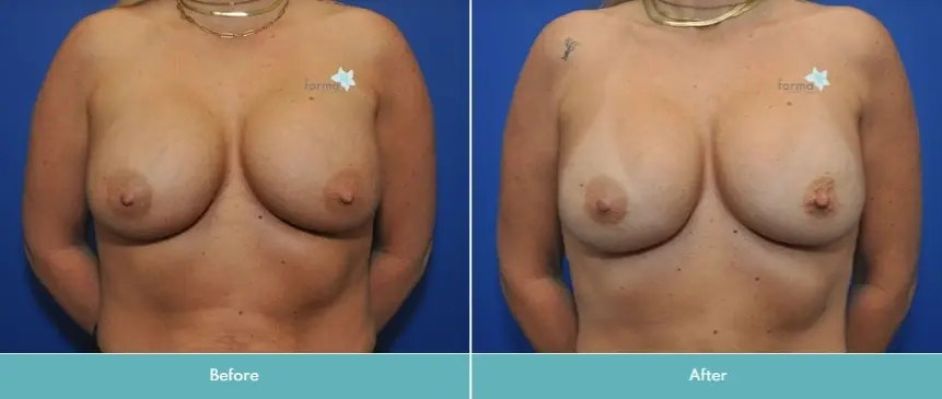 Forma Plastic Surgery breast augmentation revision result — Scottsdale, AZ