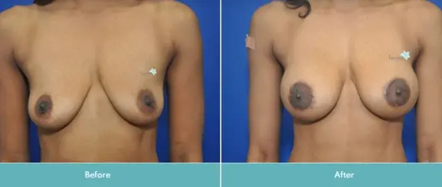 Breast Lift result at Forma Plastic Surgery in Scottsdale, AZ