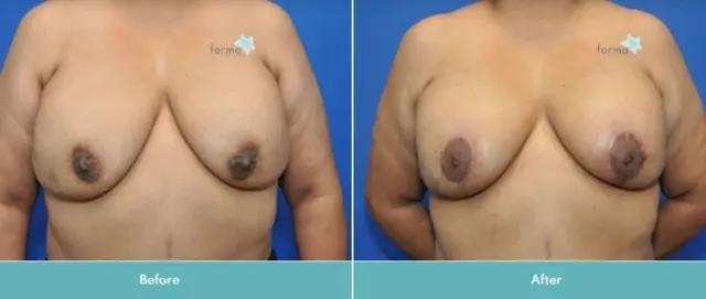 Breast Lift result at Forma Plastic Surgery in Scottsdale, AZ