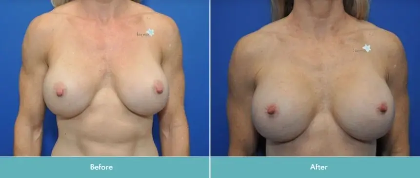 Forma Plastic Surgery breast augmentation revision result — Scottsdale, AZ