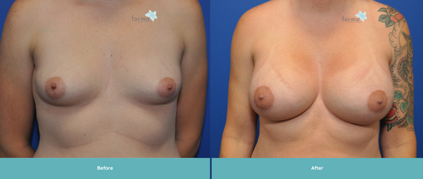 Forma Plastic Surgery breast augmentation result — Phoenix, AZ