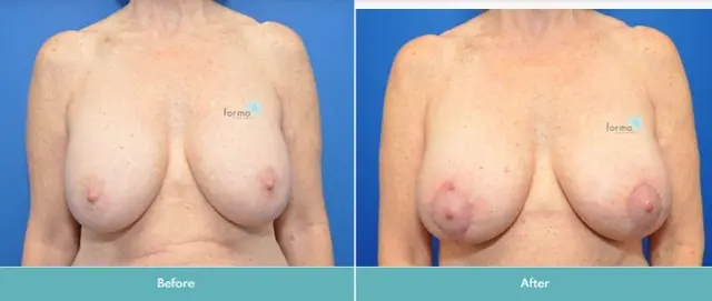 Breast Lift result at Forma Plastic Surgery in Scottsdale, AZ