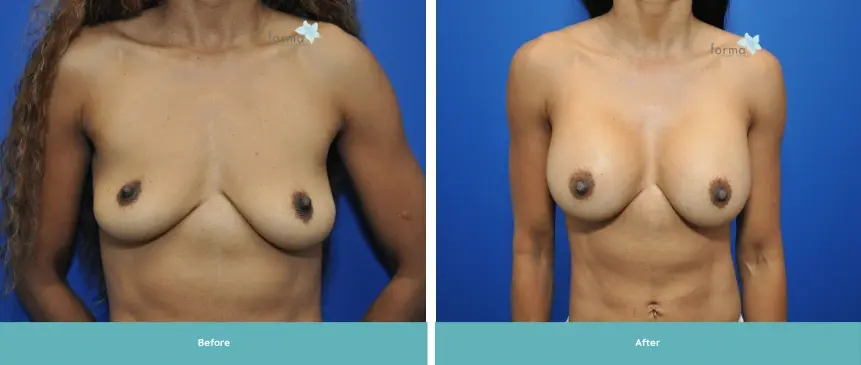 Forma Plastic Surgery breast augmentation result — Phoenix, AZ