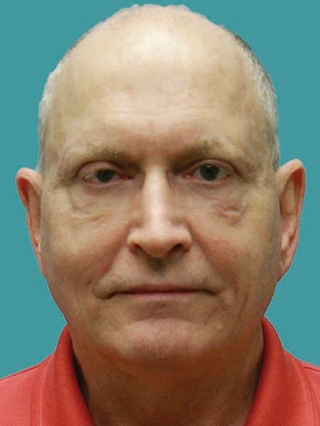 James D. Namnoum, MD fat transfer after — Atlanta, GA