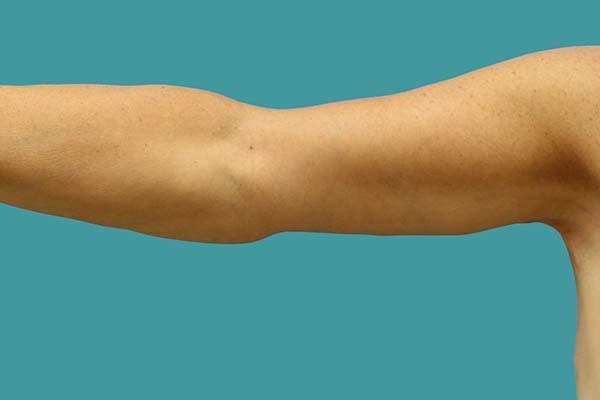 Arm Lift after at James D. Namnoum, MD in Atlanta, GA
