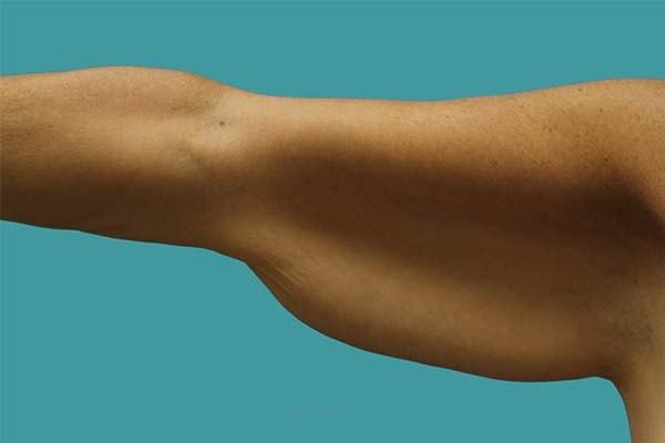 Arm Lift before at James D. Namnoum, MD in Atlanta, GA