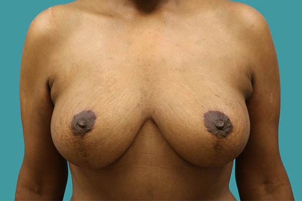 James D. Namnoum, MD breast reduction after — Atlanta, GA