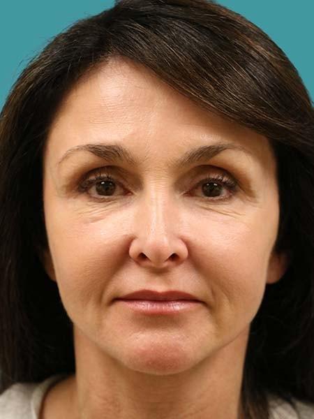 James D. Namnoum, MD fat transfer after — Atlanta, GA
