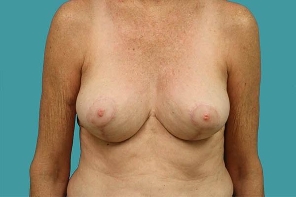 James D. Namnoum, MD breast reduction after — Atlanta, GA