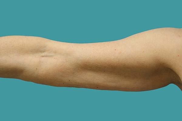 Arm Lift before at James D. Namnoum, MD in Atlanta, GA