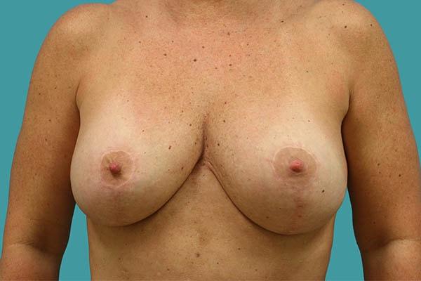 James D. Namnoum, MD breast reduction after — Atlanta, GA