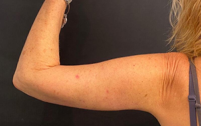 Plastic Surgery Institute - Dr. Ritu Chopra arm lift result — Beverly Hills, CA