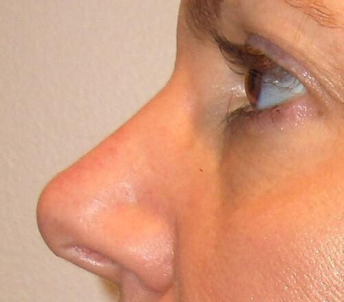 Rhinoplasty after at Plastic Surgery Institute - Dr. Ritu Chopra in Beverly Hills, CA