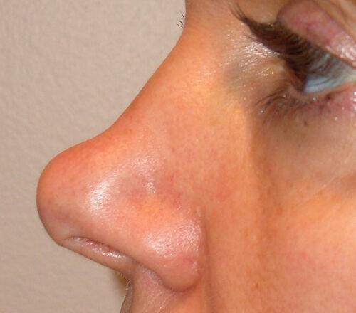Rhinoplasty before at Plastic Surgery Institute - Dr. Ritu Chopra in Beverly Hills, CA