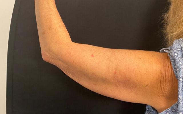 Arm Lift result at Plastic Surgery Institute - Dr. Ritu Chopra in Beverly Hills, CA