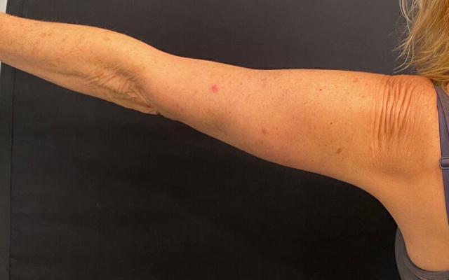 Arm Lift result at Plastic Surgery Institute - Dr. Ritu Chopra in Beverly Hills, CA