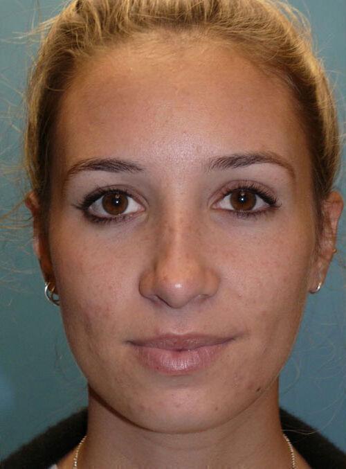 Functional Rhinoplasty after at Plastic Surgery Institute - Dr. Ritu Chopra in Beverly Hills, CA