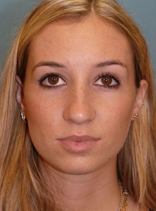 Functional Rhinoplasty before at Plastic Surgery Institute - Dr. Ritu Chopra in Beverly Hills, CA