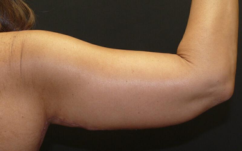 Plastic Surgery Institute - Dr. Ritu Chopra arm lift result — Beverly Hills, CA