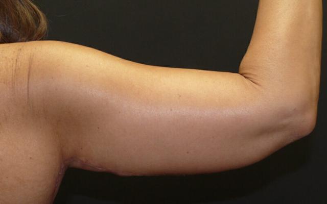 Arm Lift result at Plastic Surgery Institute - Dr. Ritu Chopra in Beverly Hills, CA