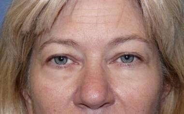 Plastic Surgery Institute - Dr. Ritu Chopra blepharoplasty result — Beverly Hills, CA