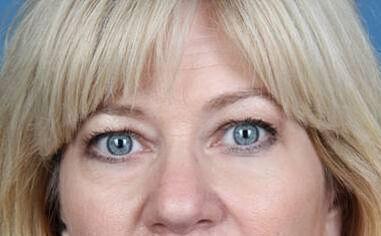 Plastic Surgery Institute - Dr. Ritu Chopra blepharoplasty result — Beverly Hills, CA