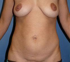 Mommy Makeover before at Plastic Surgery Institute - Dr. Ritu Chopra in Beverly Hills, CA