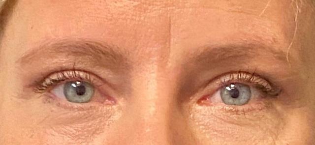 Brow Lift result at Plastic Surgery Institute - Dr. Ritu Chopra in Beverly Hills, CA
