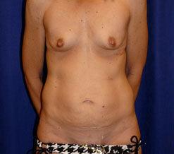 Mommy Makeover before at Plastic Surgery Institute - Dr. Ritu Chopra in Beverly Hills, CA