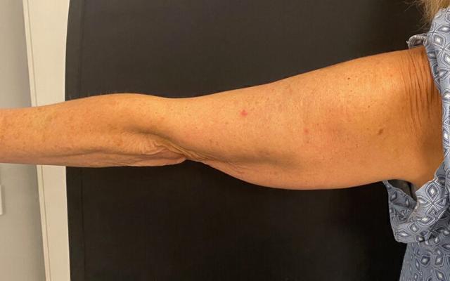 Arm Lift result at Plastic Surgery Institute - Dr. Ritu Chopra in Beverly Hills, CA