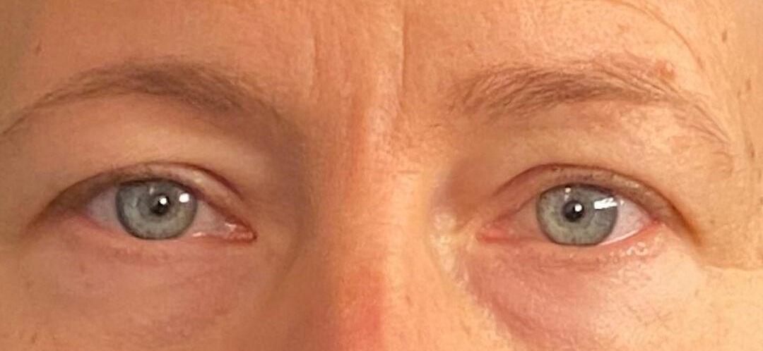 Plastic Surgery Institute - Dr. Ritu Chopra blepharoplasty result — Beverly Hills, CA
